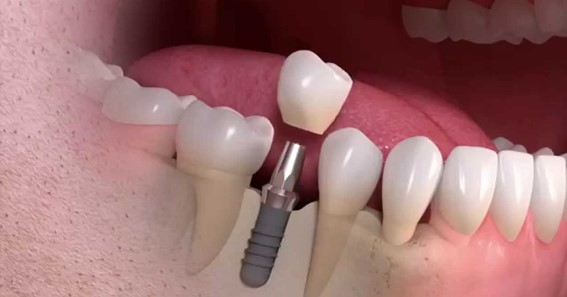 What To Look For When Finding The Best Dental Implant Center