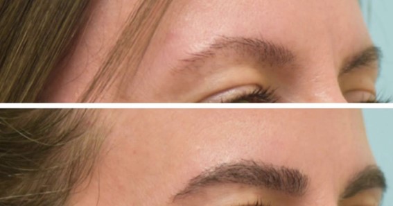 Essential Facts You Need To Know Before Getting An Eyebrow Transplant In London
