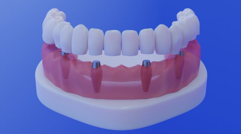 Dental Implants 101: Whats Best for Me