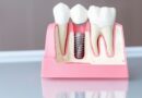 Pure Smiles - Dental Implants: what you need to know