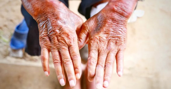 5 Obvious Signs of Scleroderma
